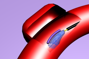 Stent-balão é desenvolvido por médico brasileiro